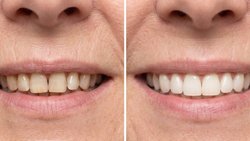Tea drinker's yellow teeth now 'much whiter after first go' using 32p-a-use fix